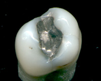 Zahnfüllung aus Amalgam